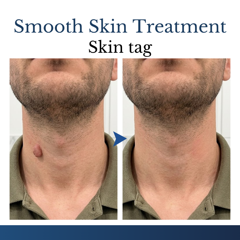 ✨Buy 1 Get 1 FREE Today Only – Clinclii® DermFixPro 2-in-1 Microneedle & Hydrocolloid Patch