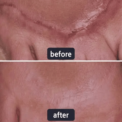 🔥Limited-time 60% sale--LOVILDS Scar Repair Cream — Smooth, Clear, Confident Skin